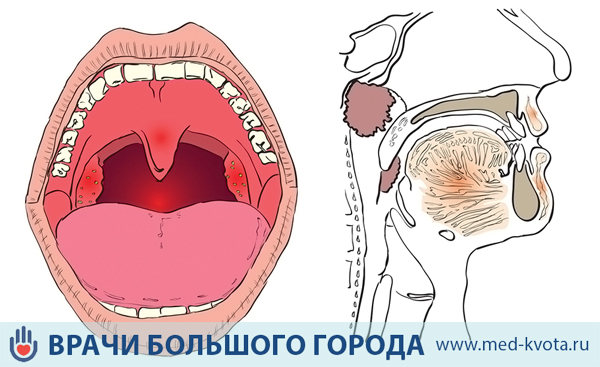 Рак голосовых связок