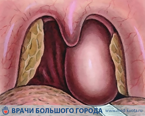 Рак голосовых связок, симптомы и признаки с фото